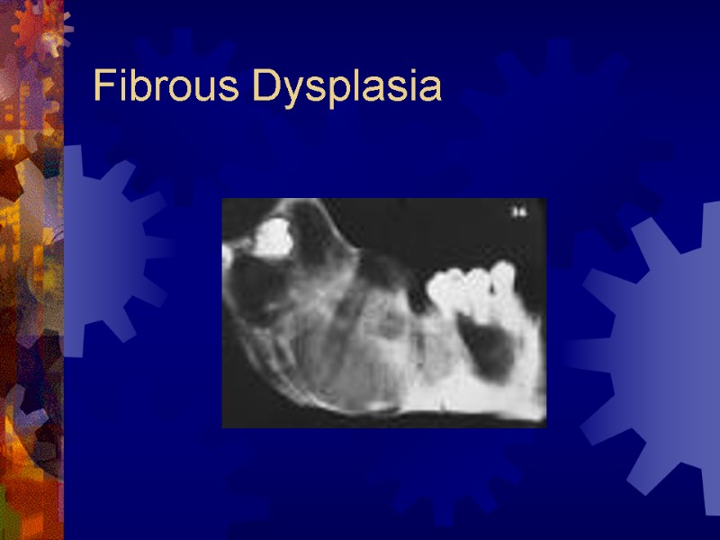 Fibrous Dysplasia